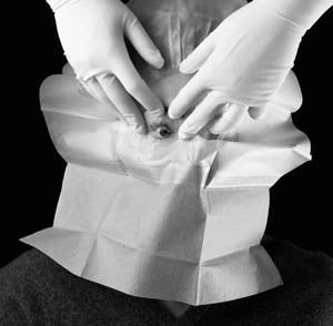 3M STERI-DRAPE OPHTHALMIC SURGICAL DRAPES 1060